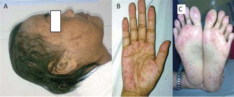 A Lupus Hair And Photosensitivity B And C Vasculitis Of Palm And Soles