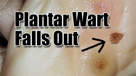 Causes of warts on your feet. How to Get Rid of Plantar Warts on Foot | Get Rid of ...