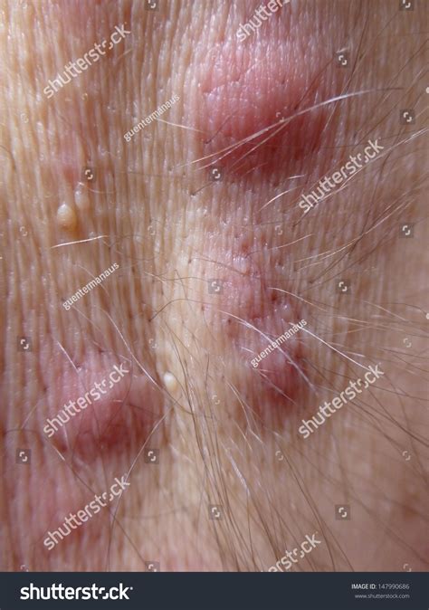 Acne Inversa Hidradenitis Suppurativa In The Armpit Stock Photo