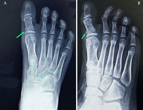 X Ray Broken Toe