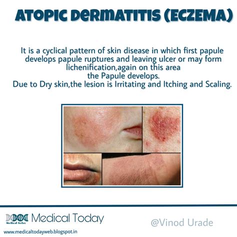 Medical Today Atopic Dermatitis Eczema