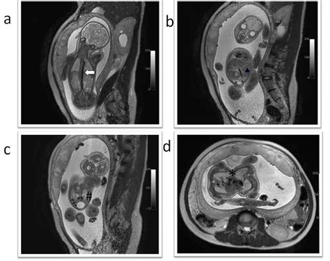 fetal mri of thoraco omphalopagus conjoined twins bmj case reports