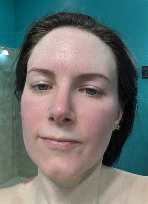 When Rosacea Flares Up I Talk About Living With Rosacea And How To Treat It