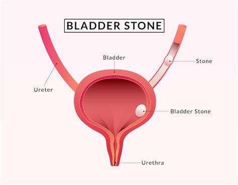 Premium Vector Stones In The Bladder Human Bladder Anatomy Medical