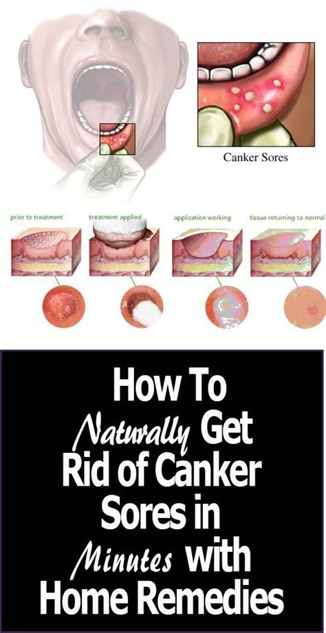 Home Remedies For Canker Sore On Tongue