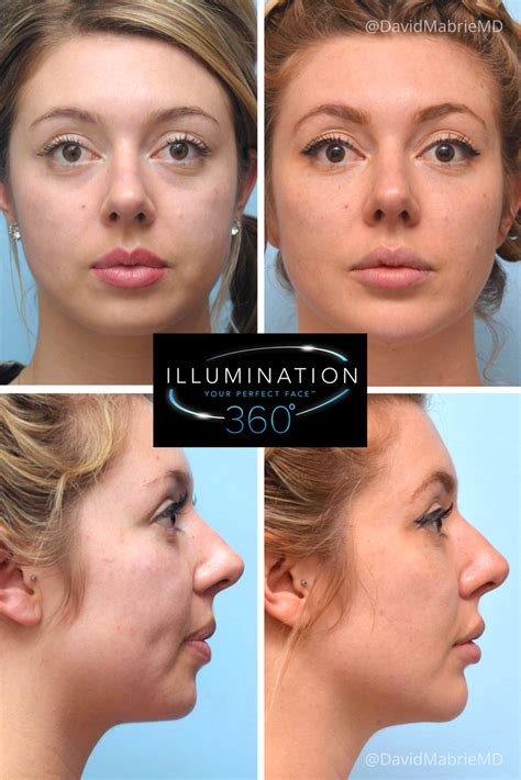 Facial Dermal Fillers Before And After Treated Areas Under Eyes