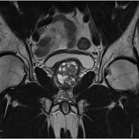 T2 Weighted Mri Scan Coronal View Shows Enlarged Prostate Growing