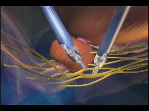 Robotic Prostatectomy Da Vinci Prostatectomy Youtube