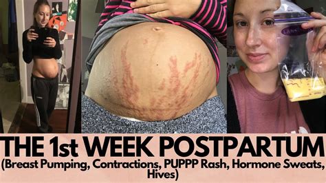 What To Expect 1 Week Postpartum Vlog Breast Pumping Puppp Rash