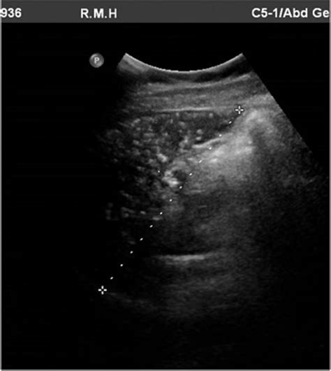 Splenic Calcification In Systemic Lupus Erythematosus Bmj Case Reports