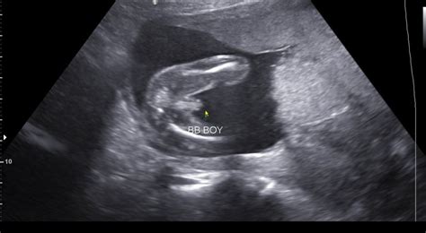 Ultrasonido De 16 Semanas De Embarazo Captions Imajinative