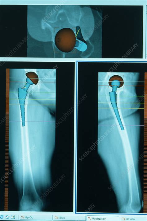 Planning Hip Replacement Operation Stock Image M6000255 Science