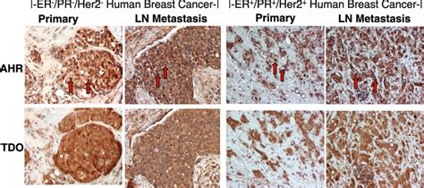 Immunohistochemistry Of Primary Breast Tumors And Patient Matched Lymph