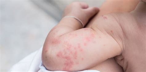 Dermatite At Pica Alergocl Nica Saiba Aqui Como Tratar