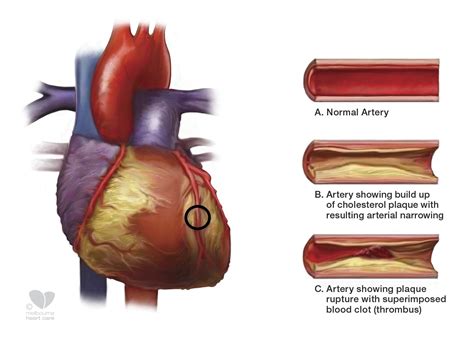 Atherosclerosis Melbourne Heart Care