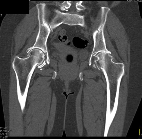 Multiple Lytic Lesions In Pelvis With Associated Sot Tissue Masses Cw