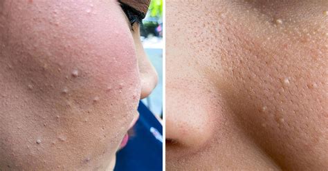 What Those Little White Bumps On Your Skin Are And What To Do About