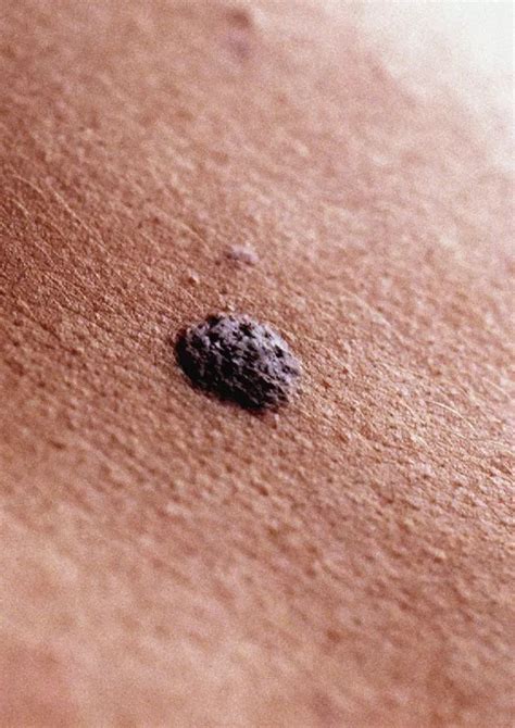 People With More Than 11 Moles On Right Arm Could Have Higher Risk Of