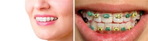 Lingual Braces Cost In South Africa Use Braces