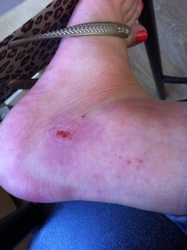 Insect Bite Causing A Swollen Ankle Carol Bassi Nee Mclaughlin Flickr