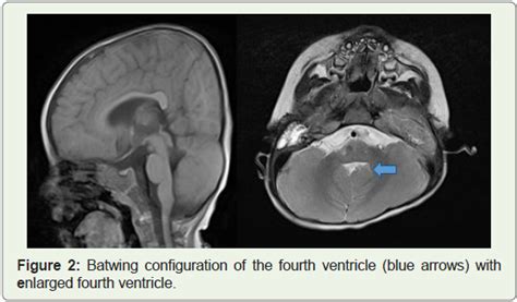 Joubert Syndrome A Rare Radiological Case In Tertiary Care Hospital