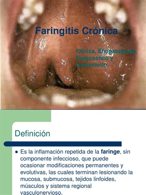 Faringitis Cronica Pdf Pdf