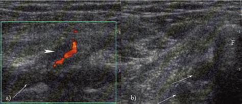 Longitudinal A And Transverse B Scan Of The Peroneal Vein Acute