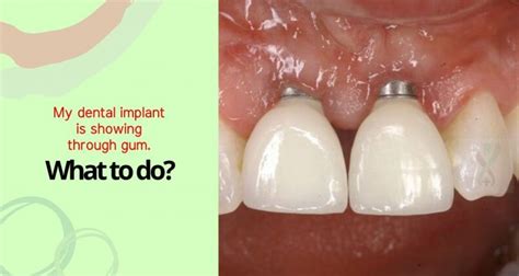 My Dental Implant Is Showing Through Gum What Do I Do Expert Dental