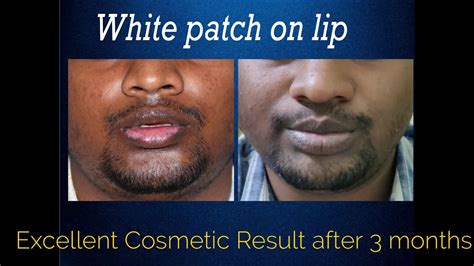 Lip Vitiligo Cosmetic Surgery With Melanocyte Transplant White Patches