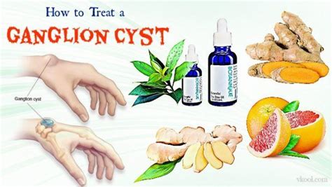 21 Ways On How To Treat A Ganglion Cyst Naturally At Home