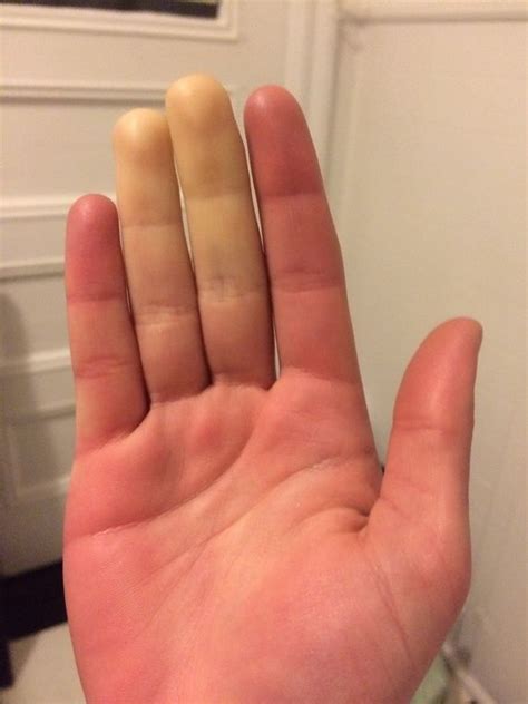 Could White Numb Fingers Be A Sign Of A Health Problem Quora