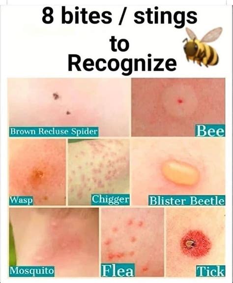 Pin By Pandora Treglia On Itchy Bug Bites Bites And Stings Itchy Bug