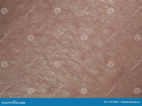 Allergic Bumps On Skin