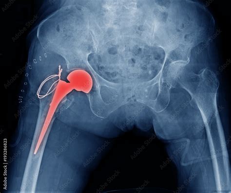 X Ray Image Hip Replacement Total Hip Arthroplasty Stock Photo Adobe