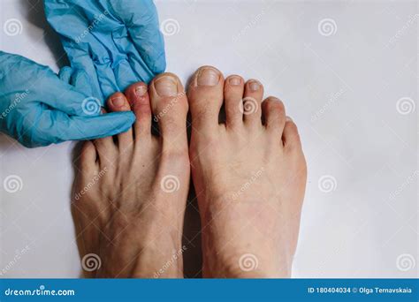 Mysterious Skin Condition That Causes Purple Blue Or Red Discoloration In Toes And Occasionally