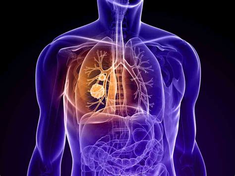 lung cancer types signs symptoms diagnosis and treatment