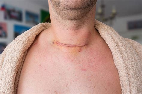 Neck Cancer Stock Photos Pictures And Royalty Free Images Istock