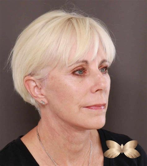 Facelift By Dr Henstrom Utah Facial Plastics 41145