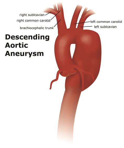 Thoracic Aortic Aneurysm Uf Health Aortic Disease Centerdiseases