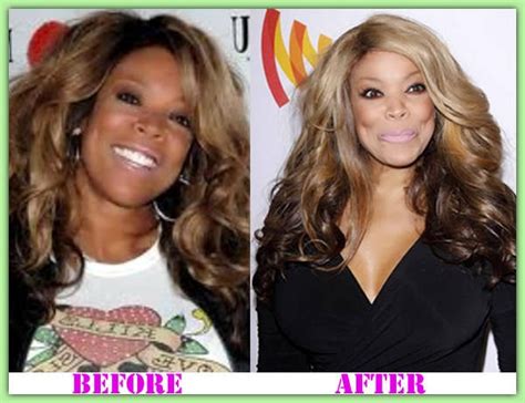 Plastic Surgery And Nose Job Wendy Williams Plastic Surgery
