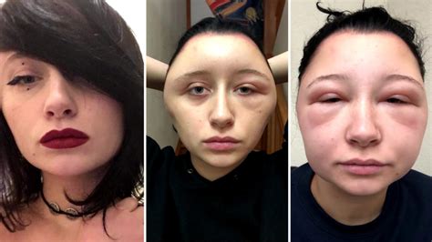 This Womans Head Doubled In Size Due To A Crazy Allergic Reaction To Hair Dye