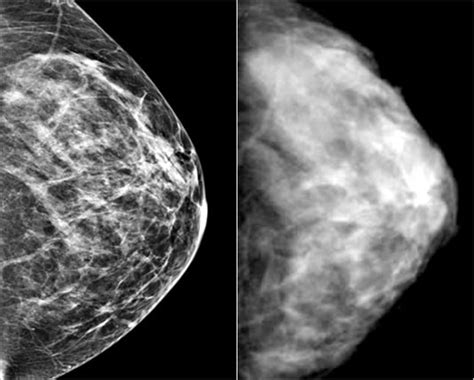 Abnormal Mammogram Findings
