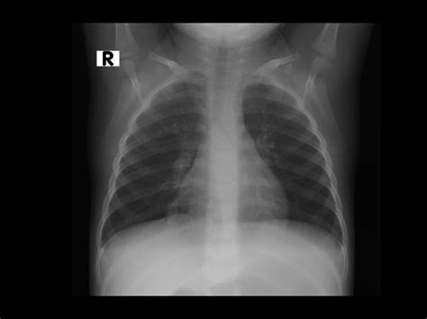 CIMCEGI Radiografía Tórax pediátrico