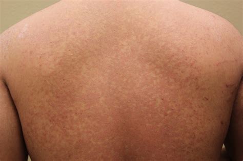Tinea Versicolor On Back Pictures Photos