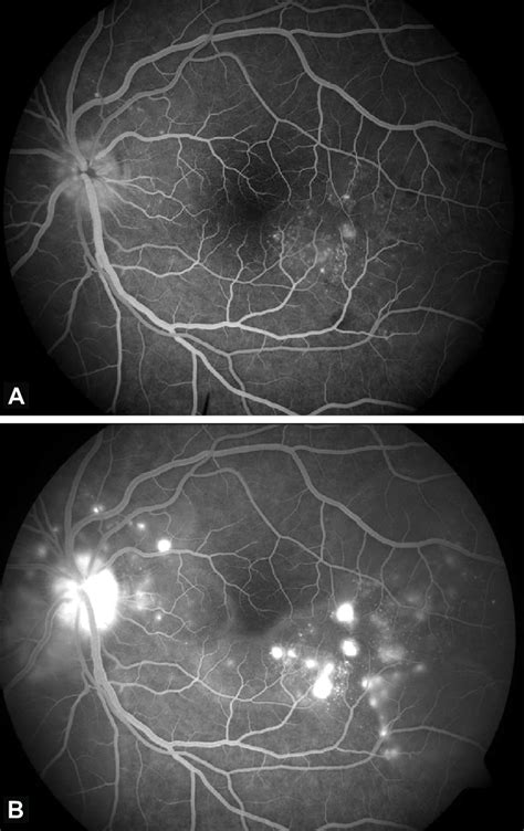 A Fundus Fluorescein Angiography Of The Left Eye Showing Multiple