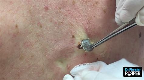 Pimple popper remove a huge scalp lipoma. Massive Blackhead Popped by Dr. Pimple Popper | The ...