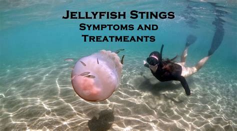 Jellyfish Stings Symptoms Treatment And Tips To Avoid Getting Stung