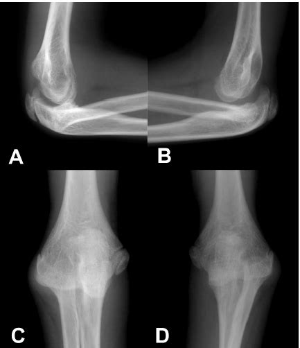 At Age 13 Posterior Radial Head Dislocation In Both Elbows With A