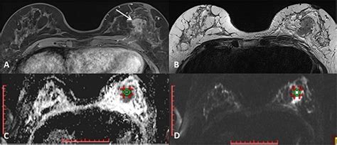Frontiers Differentiation Of Breast Lesions And Distinguishing Their