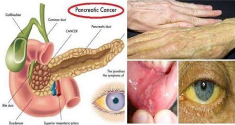 Warning Signs Of Pancreatic Cancer Best Herbal Health